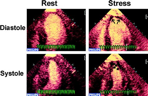 pulse dropped during stress test|echocardiogram stress test results.